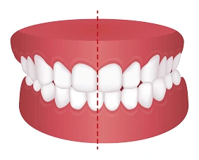 Crossbite